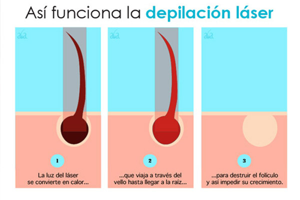 Como funciona la depilacion laser